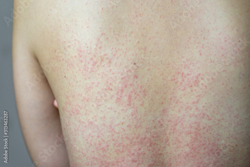 Close Up Allergy Rash Around Back View Of Asian Women With Dermatitis