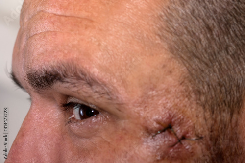 Medical sutures on the face after surgery on the temporal bone. Suture wound at the temple. Stitched skin on the face of a young man after surgery