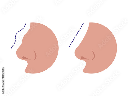 Nose before and after rhinoplasty correction