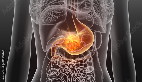 Stomach cancer. medically 3D illustration_2 photo