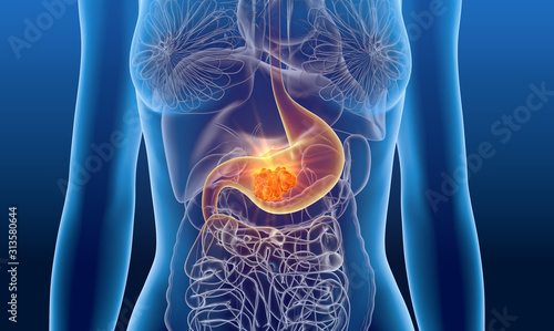 Stomach cancer. medically 3D illustration photo