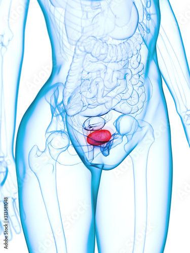 3d rendered medically accurate illustration of a diseased bladder