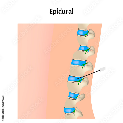 Epidural anesthesia during childbirth. Epidural anesthesia of pregnant women. Vector illustration.