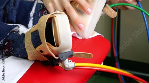 Device for the feet of children diagnosed with cerebral palsy with a rehabilitation tool to normalize muscle tone in the lower extremities, the doctor helps the child to restore walking skills. photo