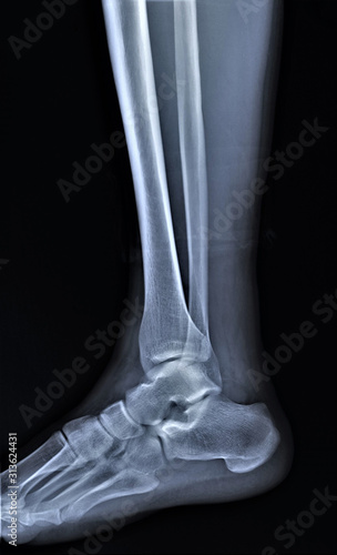 normal radiography of the ankle joint in the lateral projection