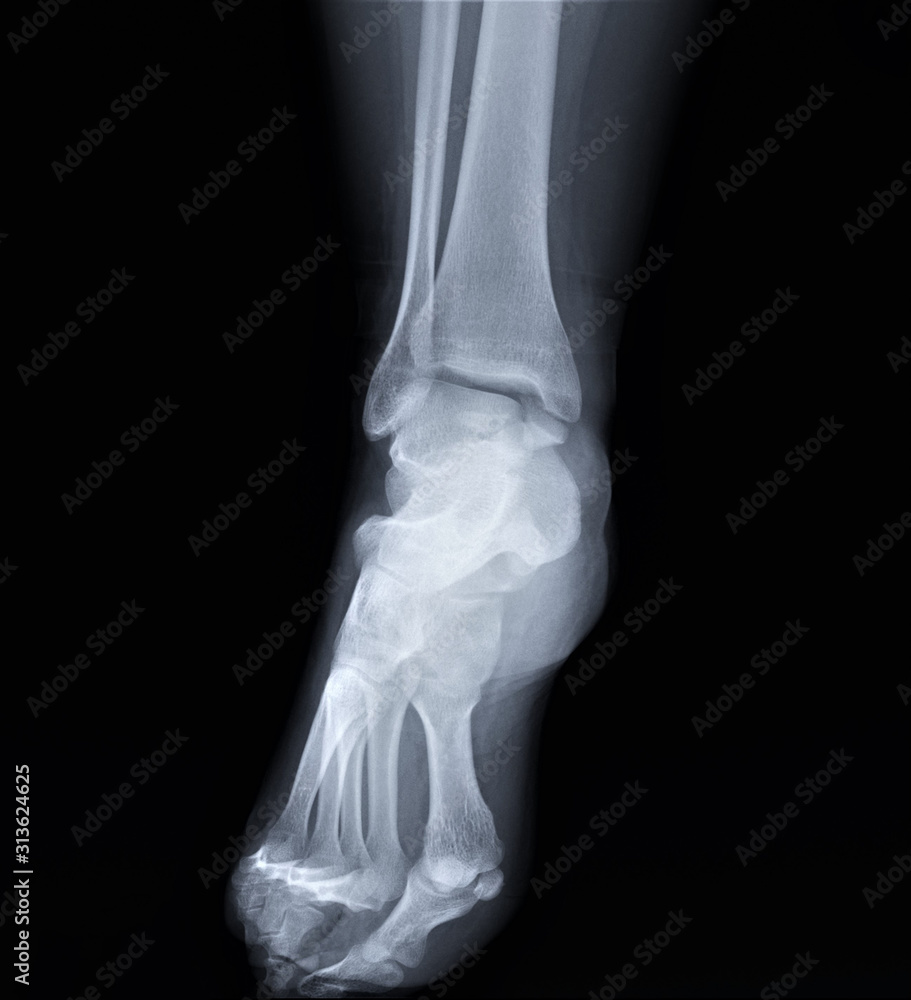 x-ray of the ankle joint in direct projection x-ray of the ankle joint in direct projection