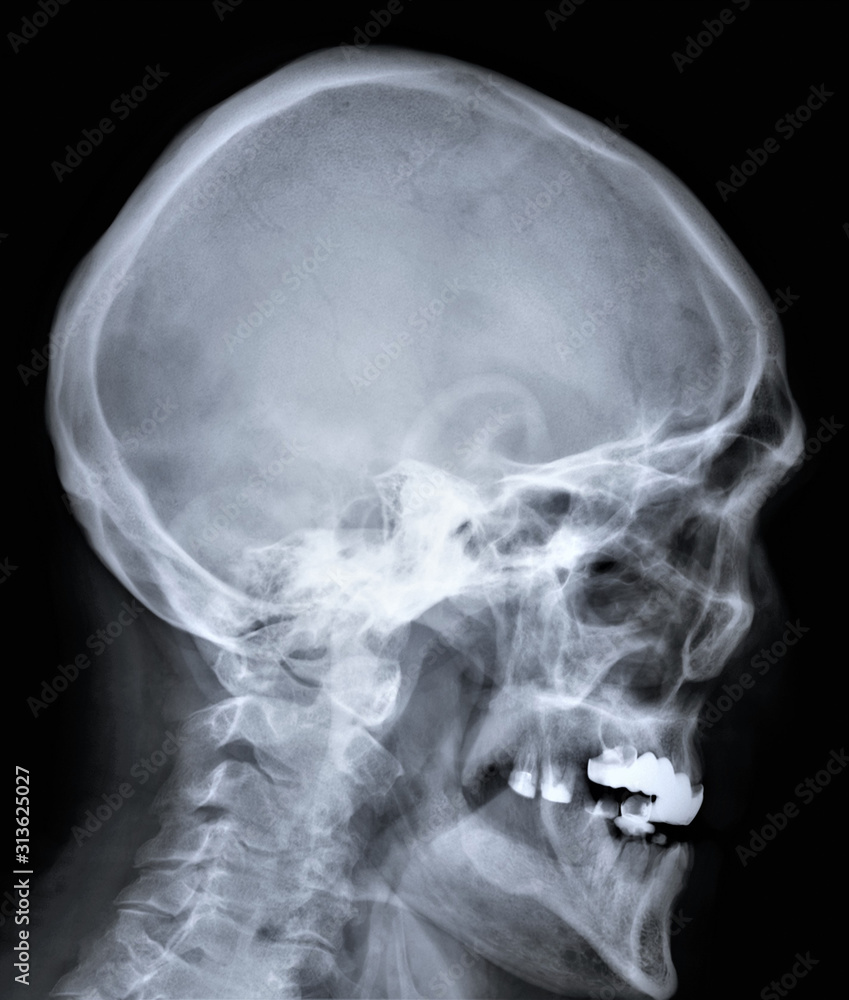 x-ray of the skull with the cervical spine x-ray of the skull with the cervical spine