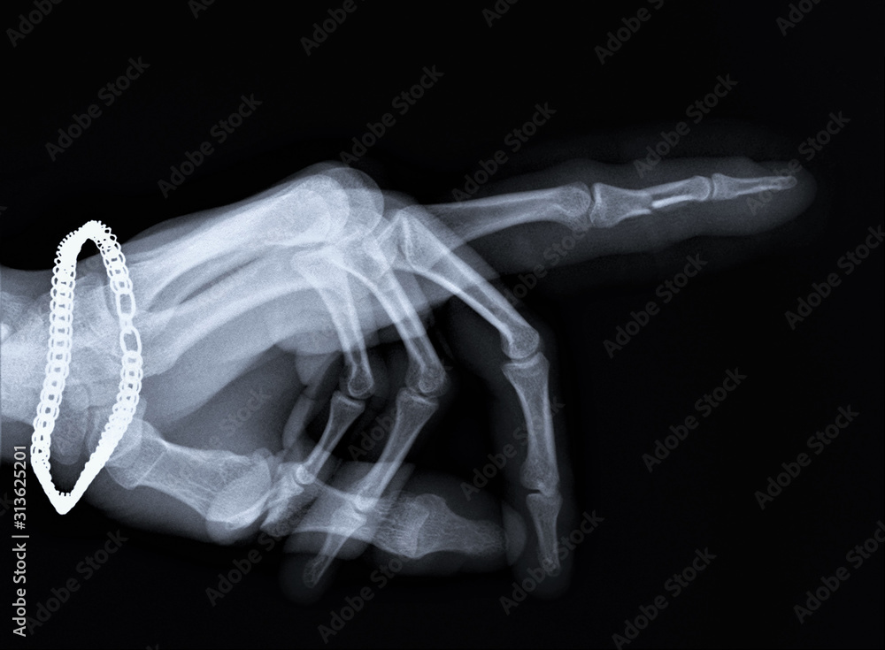 Naklejka premium x ray with a fracture of the middle phalanx 2 fingers of the hand