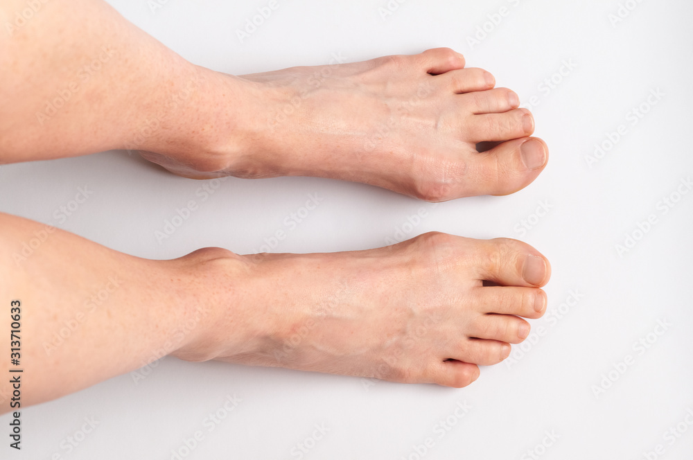 Bunions. Hallux valgus, feet isolated. Middle-aged woman's feet seen from above. Bunions. Hallux valgus, feet isolated. Middle-aged woman's feet seen from above.