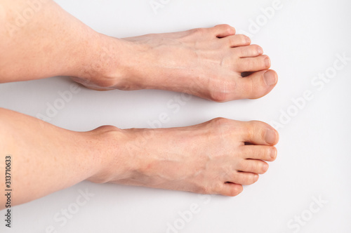 Bunions. Hallux valgus, feet isolated. Middle-aged woman's feet seen from above.