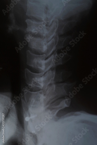 Magnetic resonance image of human spine. X-ray of the spinal column, side view. Lateral xray of neck and cervical spine, fixation with pedicle screw and rod . Medical health care concept.