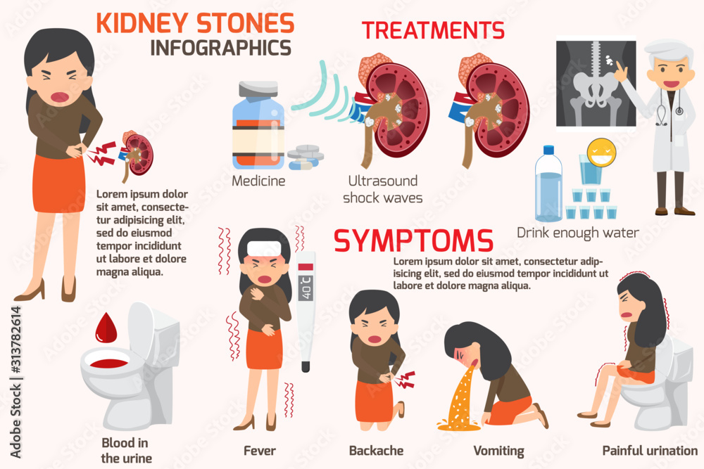 Image result for What Triggers Kidney Stones? infographics