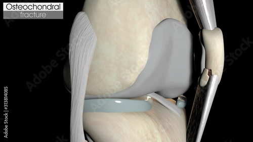 Osteochondral Patella Fracture photo