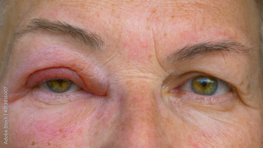 Naklejka premium CLOSE UP: Caucasian lady with an infected and swollen eye looks into the camera.