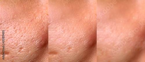 Comparison of skin before and after laser resurfacing. Skin with acne, acne scars, enlarged pores.