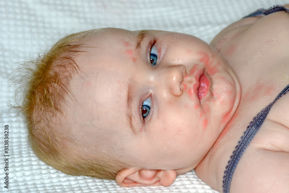 Allergy baby skin dermatitis food. child dermatitis symptom problem