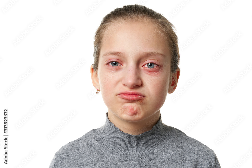 Allergic reaction, skin rash, close view portrait of a girl's face. Redness and inflammation of the skin in the eyes and lips. Immune system disease. Allergic reaction, skin rash, close view portrait of a girl's face. Redness and inflammation of the skin in the eyes and lips. Immune system disease.