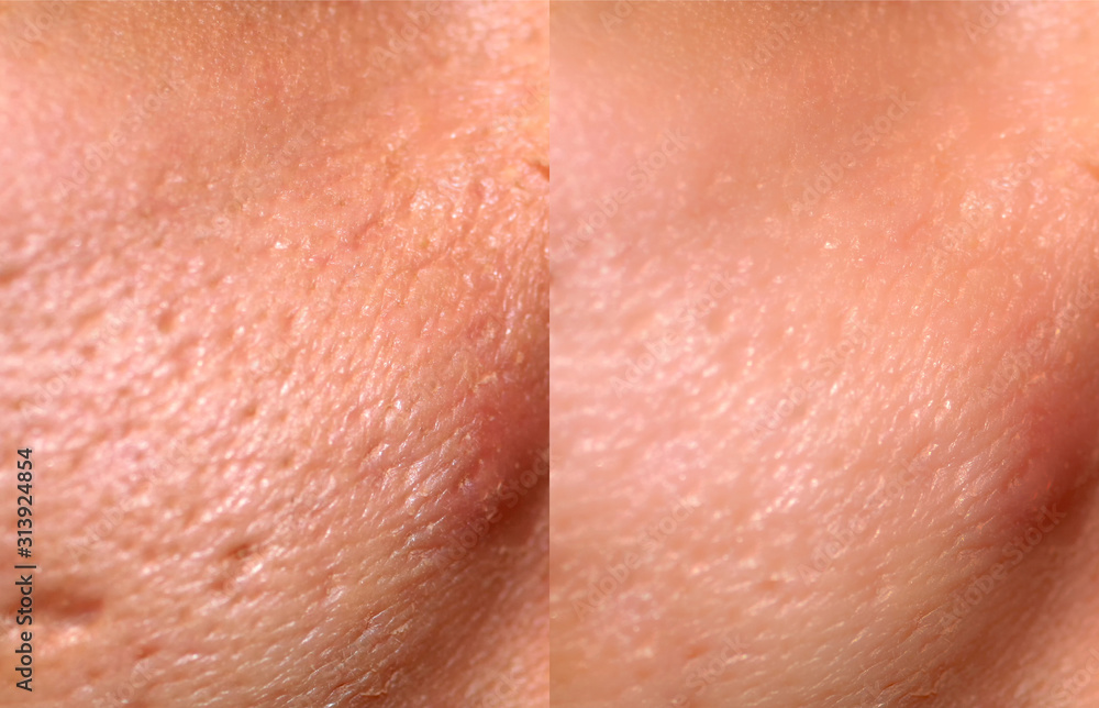 Comparison of skin before and after laser resurfacing. Skin with acne