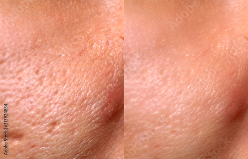 Comparison of skin before and after laser resurfacing. Skin with acne, acne scars, enlarged pores.