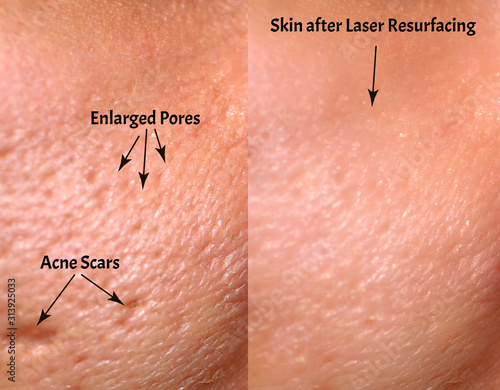 Comparison of skin before and after laser resurfacing. Skin with acne, acne scars, enlarged pores.