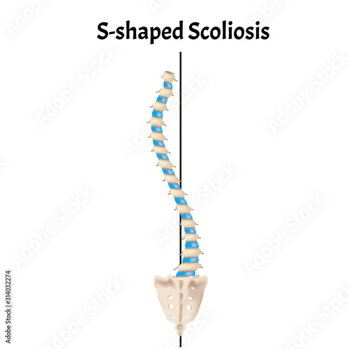 S-shaped scoliosis. Dextroscoliosis. Levoscoliosis. Spinal curvature  kyphosis  lordosis  scoliosis  arthrosis. Infographics. Vector illustration on isolated background.
