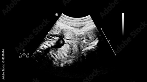 Ultrasound screen with fetal echocardiography. © faustasyan