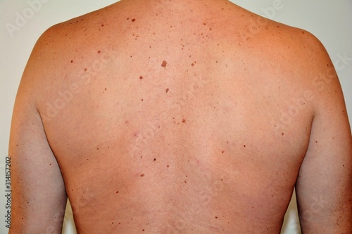 the back of a man with spots and moles