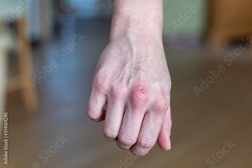 Nasty unpleasant burn on middle-aged white woman's hand from carelessness from handling hot oven