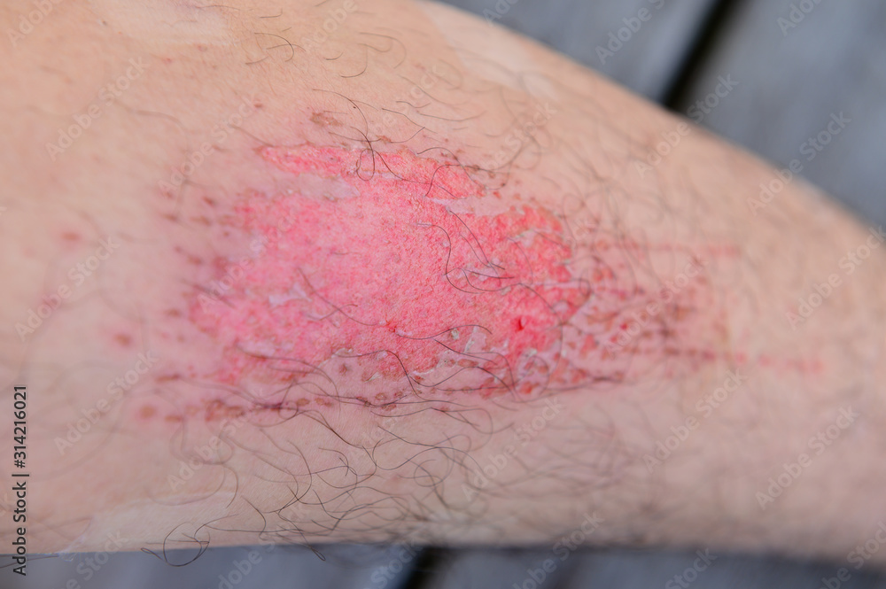 Fototapeta premium Closeup human legs with fresh wound