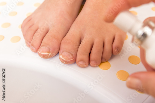 Feet with fungal toe nail infection
