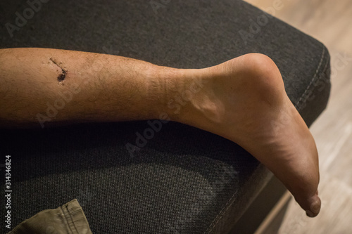 Overview of a healing wound and torn muscle on a leg. Visible scar, dried skin, stitch marks and shaven hair. Exposed part of a right lower leg.