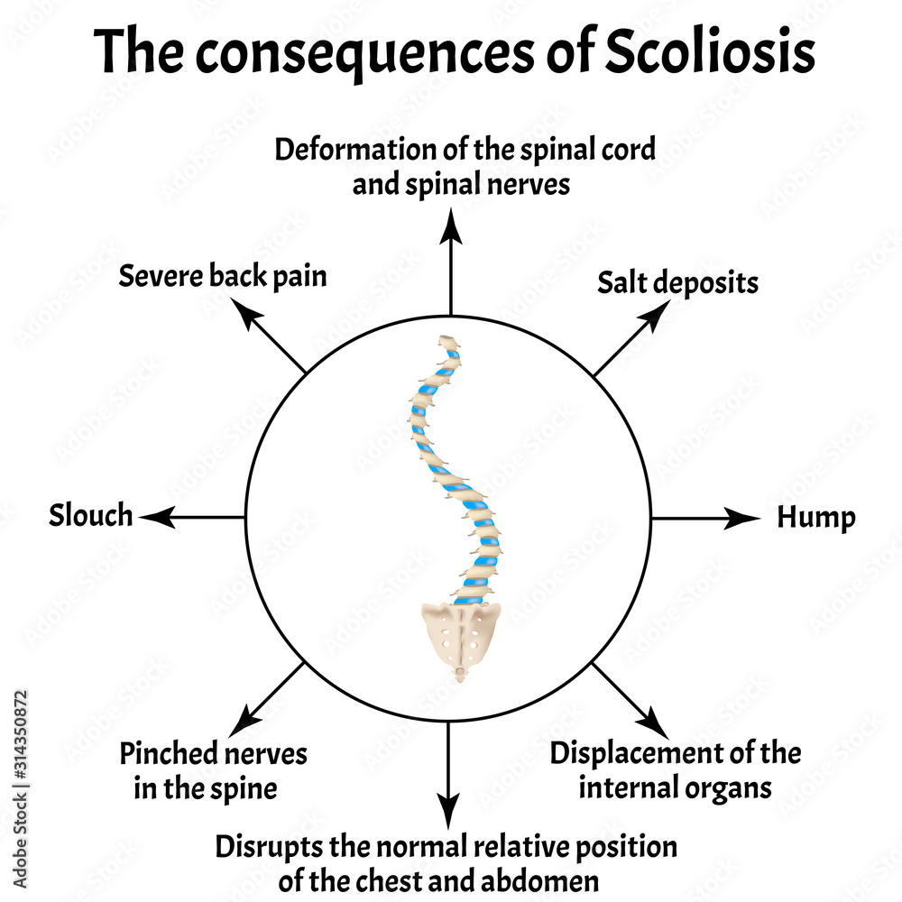 The consequences of scoliosis. Spinal curvature, kyphosis, lordosis of the neck, scoliosis