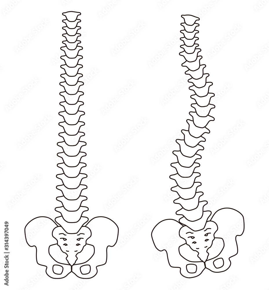 まっすぐな背骨 歪んだ背骨 脊椎側弯症 Stock Illustration Adobe Stock まっすぐな背骨 歪んだ背骨 脊椎側弯症 Stock Illustration Adobe Stock