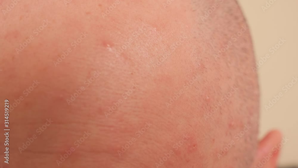 Close-up of a rash on the skin of an adult male. A man has varicella