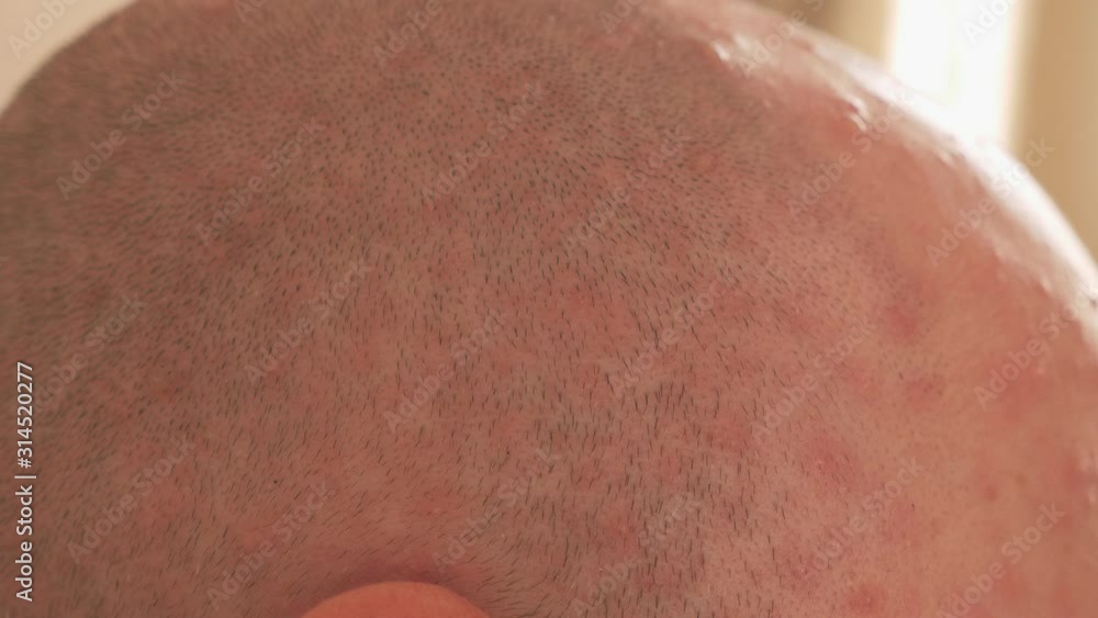 Close-up of a bald man's head with a rash on the skin from chickenpox ...