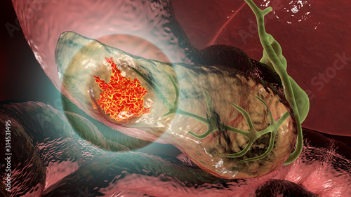 Quadro su tela Pancreatic cancer, malignant tumor of pancreas