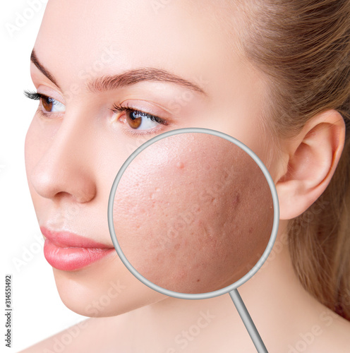 Magnifying glass shows skin before and after postacne treatment.