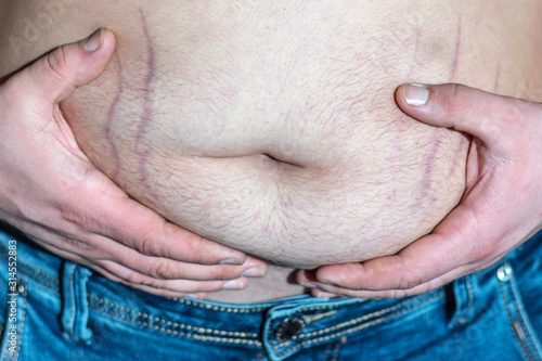 Man's fat belly with stretch marks. photo