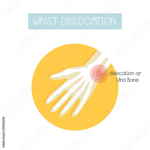 Illustration in a flat style of wrist dislocation.