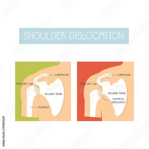 Illustration of a healthy shoulder and dislocation
