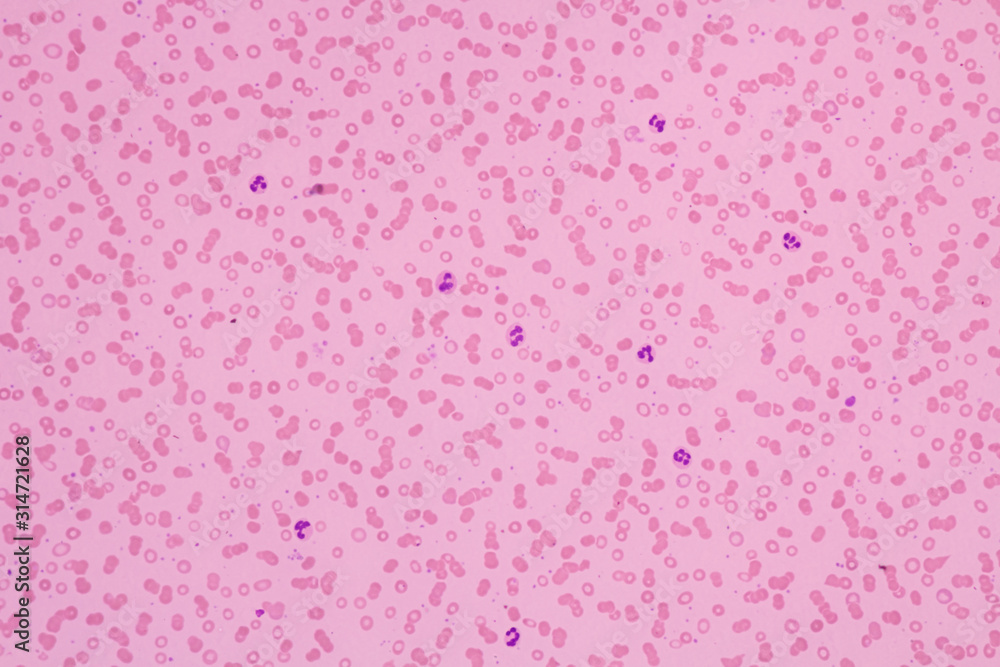 Human blood smear view in microscopy.Complete blood count for treatment. Polymorphonuclear cells(PMNs), eosinophils and lymphocytes.Hematology laboratory.Medical background.Magnification 600 x.