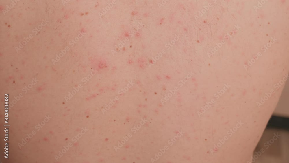 Close-up of chicken pox on the back of an adult male. Adult man who having varicella blister or chickenpox on a back, chicken pox disease.