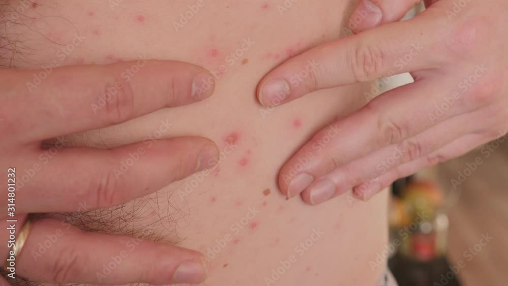 Closeup of a man scratching his skin on which rashes from chicken pox. Itching on the skin for chickenpox in an adult male. Closeup of a man scratching his skin on which rashes from chicken pox. Itching on the skin for chickenpox in an adult male.
