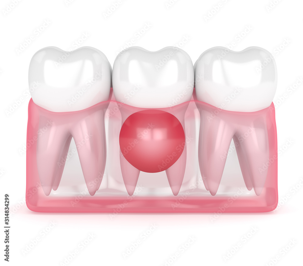 3d render of teeth in gums with cyst 3d render of teeth in gums with cyst