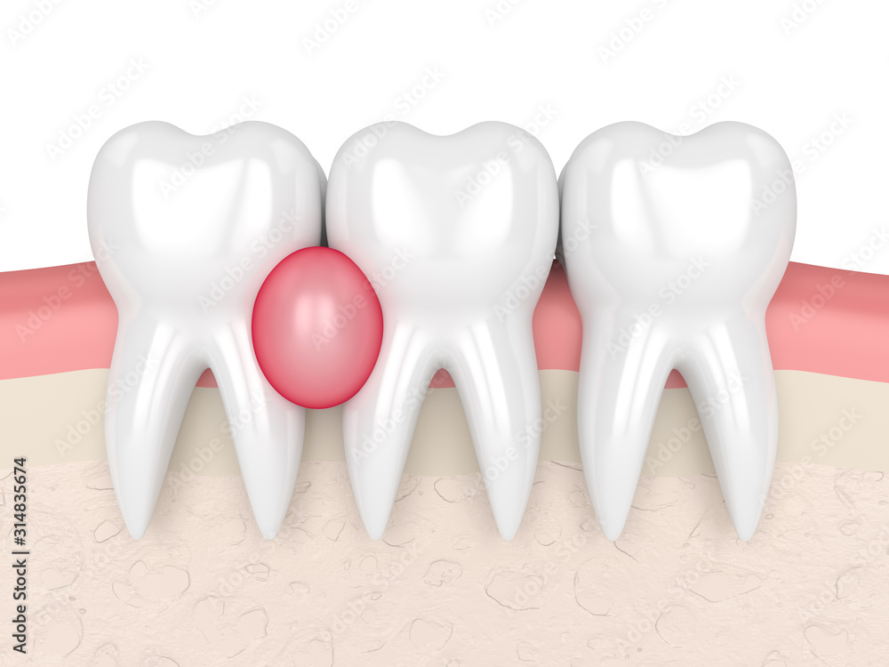 3d render of teeth in gums with cyst 3d render of teeth in gums with cyst