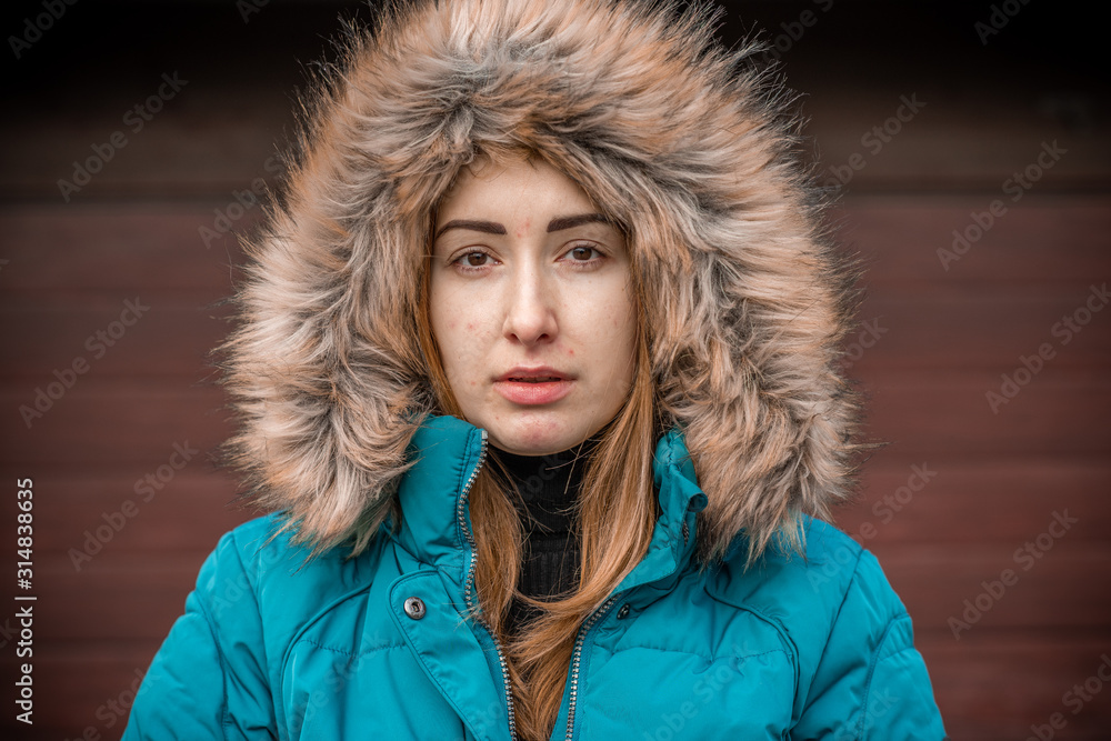 Acne and scars, simple woman close up natural portrait, No makeup and retouch. Problem skin Acne and scars, simple woman close up natural portrait, No makeup and retouch. Problem skin