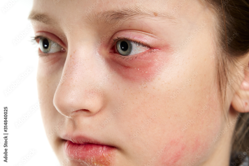 Allergic reaction, skin rash, close view portrait of a girl's face. Redness and inflammation of the skin in the eyes and lips. Immune system disease. Allergic reaction, skin rash, close view portrait of a girl's face. Redness and inflammation of the skin in the eyes and lips. Immune system disease.
