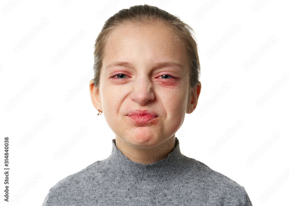 Allergic reaction, skin rash, close view portrait of a girl's face. Redness and inflammation of the skin in the eyes and lips. Immune system disease. Allergic reaction, skin rash, close view portrait of a girl's face. Redness and inflammation of the skin in the eyes and lips. Immune system disease.
