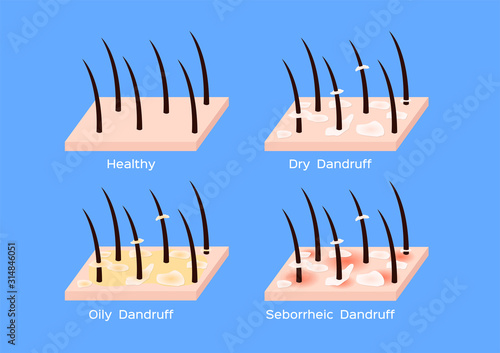 Dandruff on hair vector , closeup on skin vector , seborrhea photo