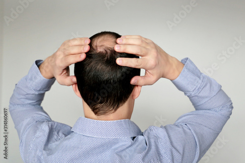 Baldness, man in office shirt concerned about hair loss. Male head with a bald, concept of stress at work